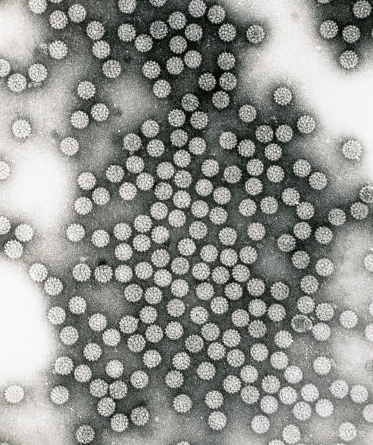 몰리브덴산암모늄에 의해 음성 염색된 인유두종바이러스의 현미경 사진./한마음창원병원/